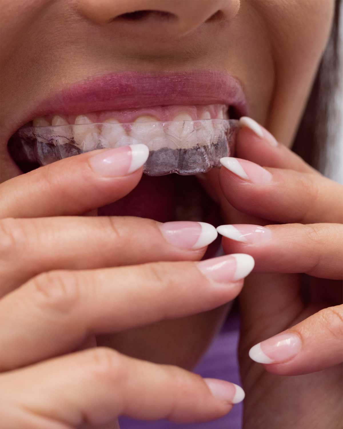TPD-female-patient-wearing-braces